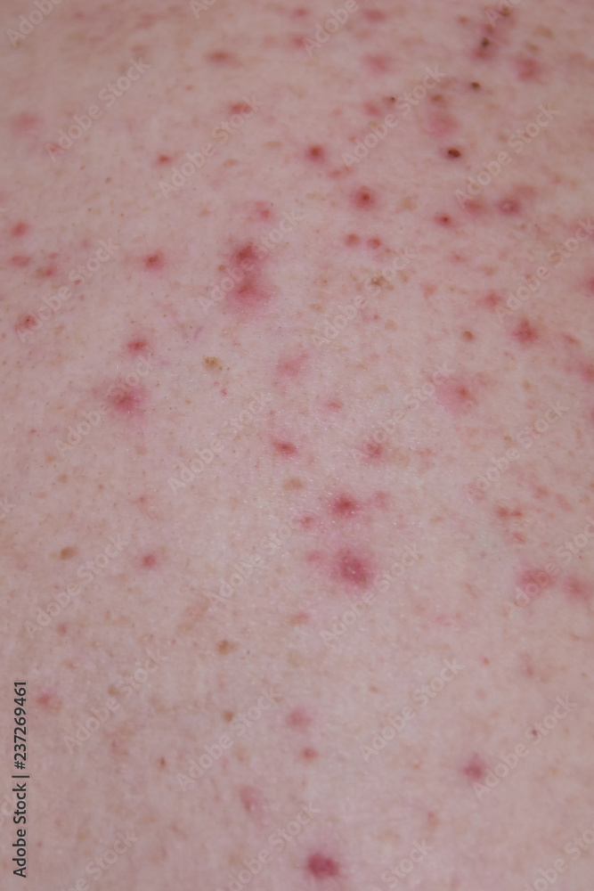 Fototapeta premium Problem skin. Acne on the skin. Texture of oily problem skin