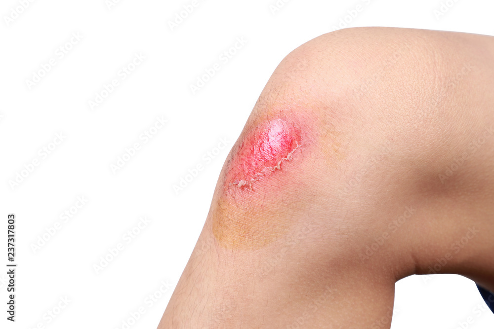 Fototapeta premium Asian boy got accident painful wound, scraped or injured on knee in football game. Close up of bleeding scraped after run accident isolated on white background.