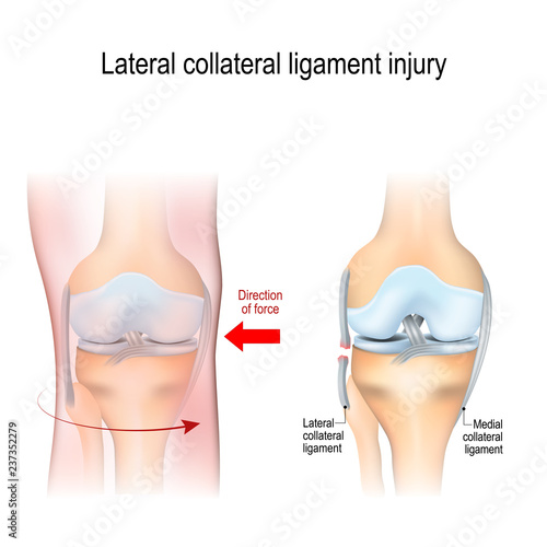 Fibular collateral ligament injury. joint anatomy.