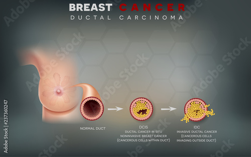 Breast cancer anatomy illustration, Ductal carcinoma of the breast, detailed medical illustration. Normal duct, Ductal cancer in situ and invasive ductal cancer.