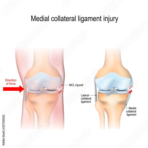 Medial knee injuries.