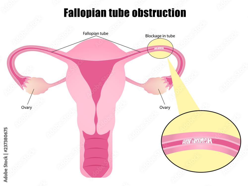 Plakat Obstruction of the fallopian tubes, An Overview of Tubal