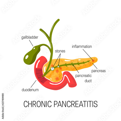 Chronic pancreatitis concept. Vector illustration