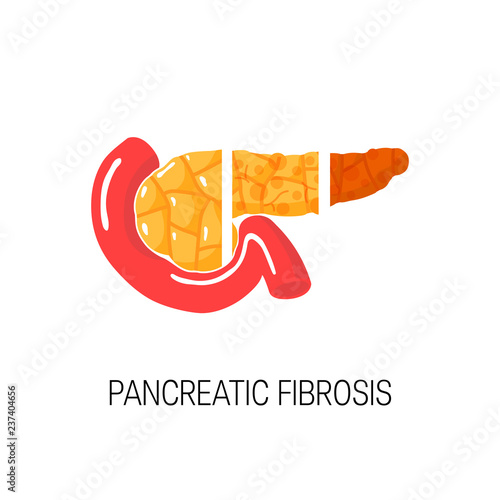 Pancreatic fibrosis concept. Vector illustration