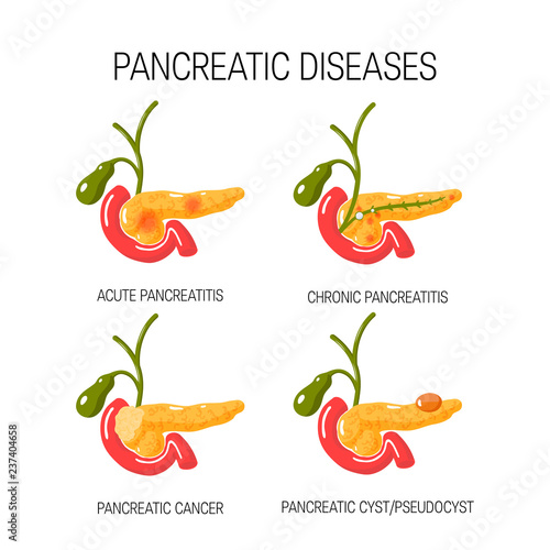 Diseases of the pancreas concept. Vector illustration