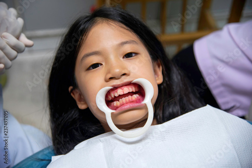 Frontal view of young Asian girl white teeth with retractor in dental office. Kid met the dentist for routine dental checkup or examination and fluoride treatment. Fluoride application process.