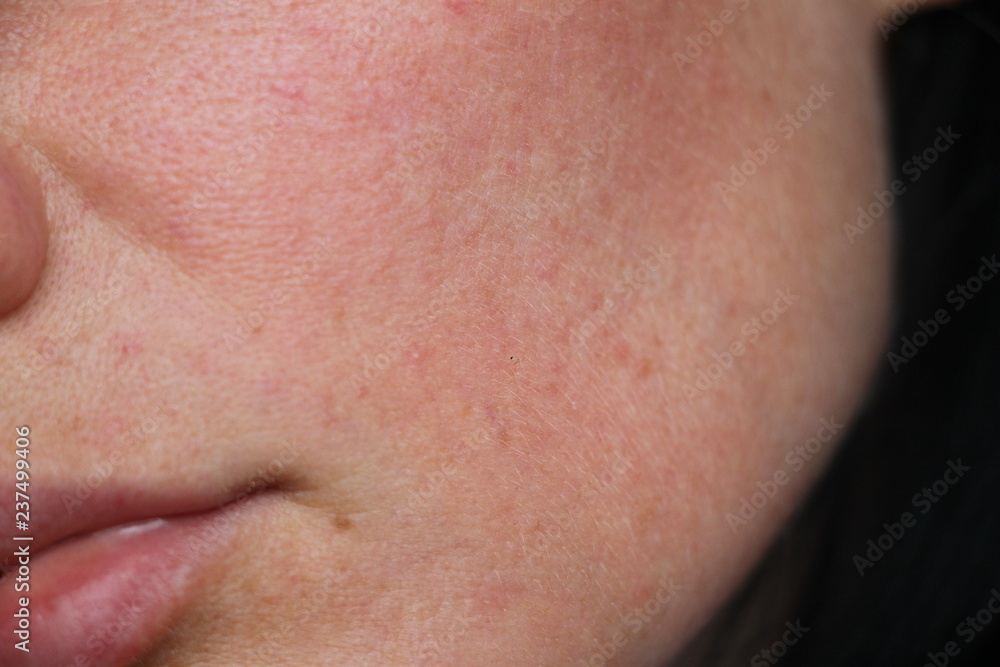 acne on the face. pores on the face acne on the face. pores on the face
