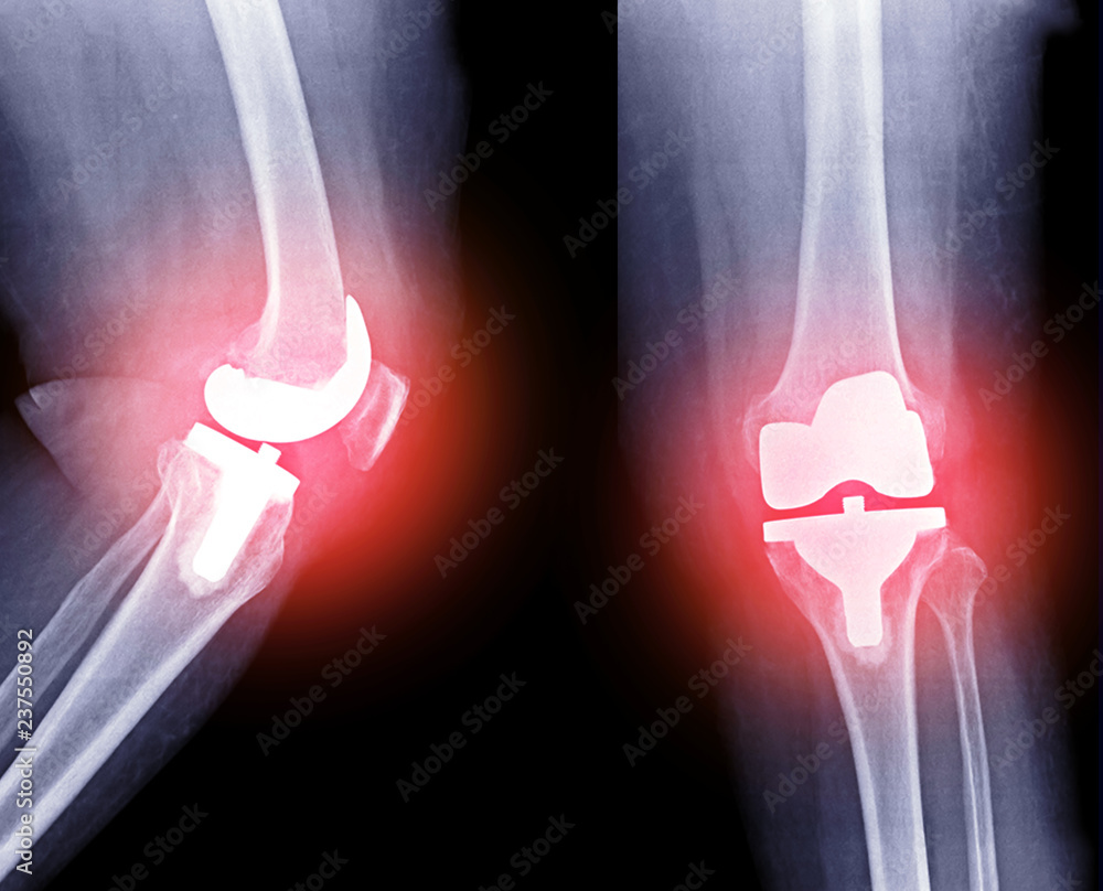 Xray image of Right knee joint replacement (red color glow)/ knee
