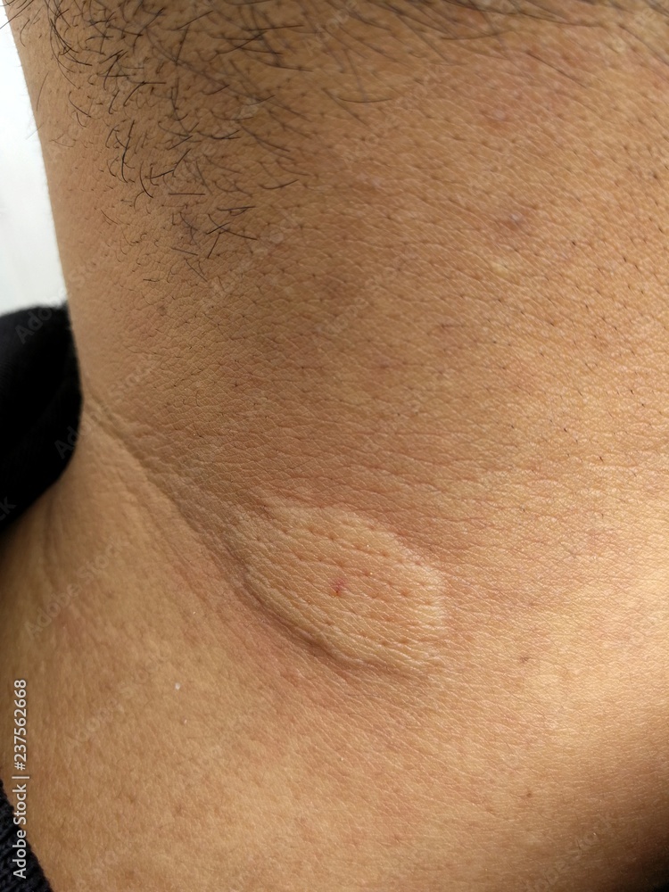 Fototapeta premium man neck after bee stings
