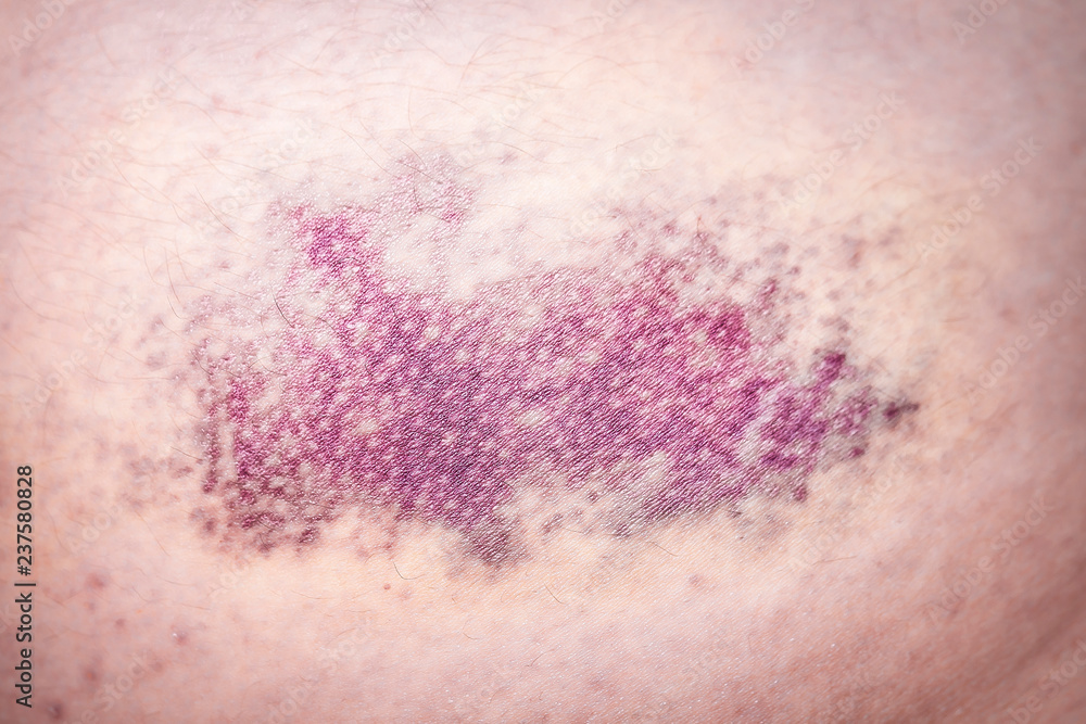 close up of bruise hit on the leg, hematoma close up of bruise hit on the leg, hematoma