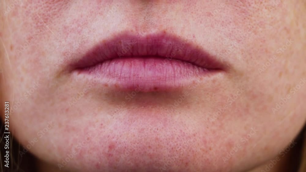 Pimples on chin. Problem skin. Acne on the face. Examination by a doctor Pimples on chin. Problem skin. Acne on the face. Examination by a doctor