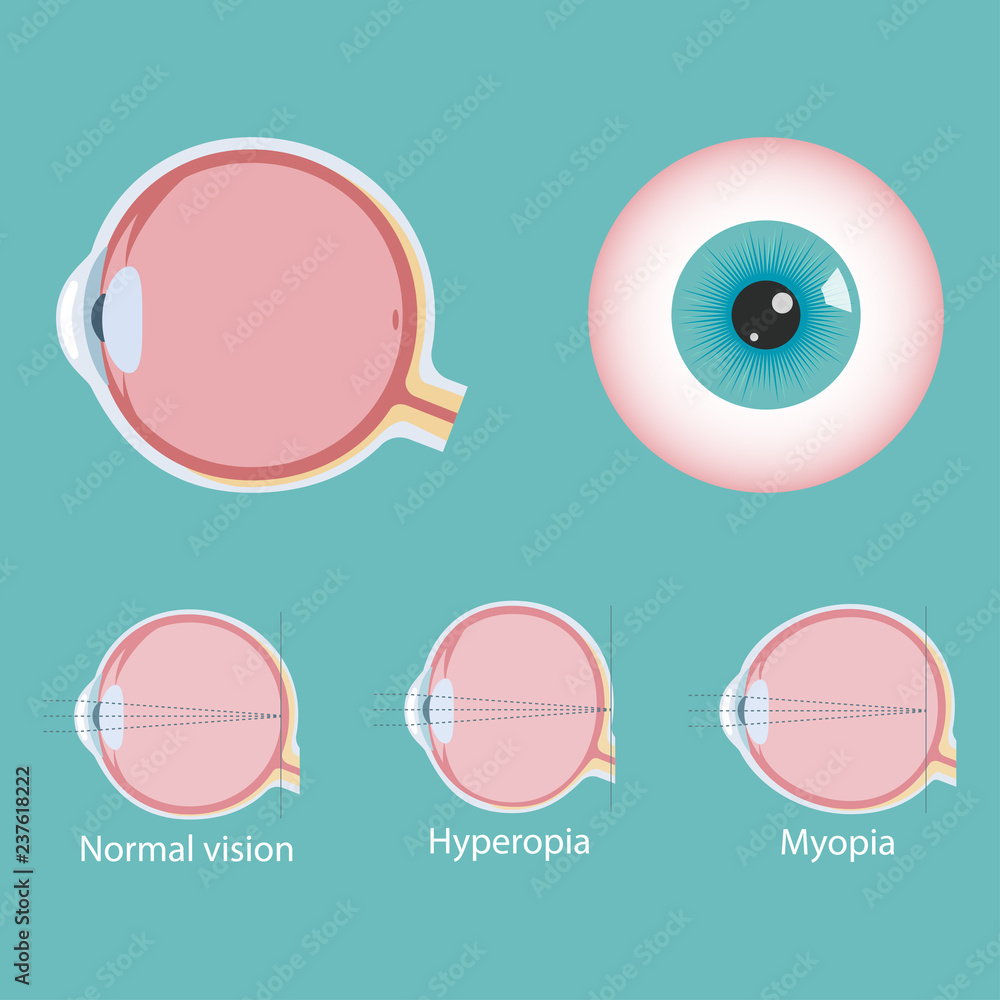 Ophthalmic concept, eye defects. Normal vision, Hyperopia, Myopia. Vector illustration. Ophthalmic concept, eye defects. Normal vision, Hyperopia, Myopia. Vector illustration.