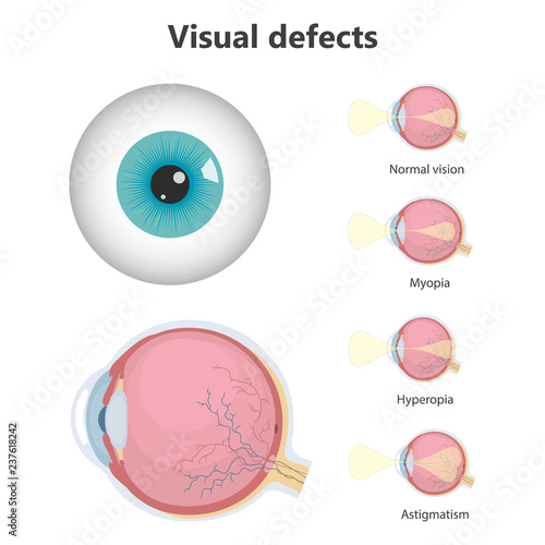 Ophthalmic concept, eye defects. Normal vision, Hyperopia, Myopia. Vector illustration.