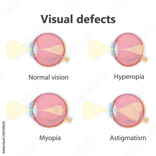 Ophthalmic concept, eye defects. Normal vision, Hyperopia, Myopia. Vector illustration.