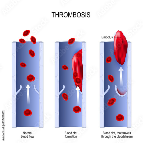 thrombosis. embolism
