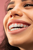 Beautiful young woman with teeth braces on pink