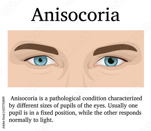 Illustration of Anisocoria
