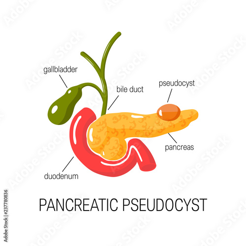 Pancreatic pseudocyst concept. Vector illustration