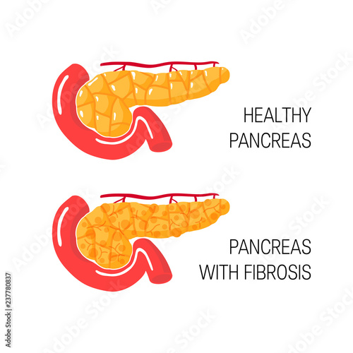 Pancreatic fibrosis concept. Vector illustration