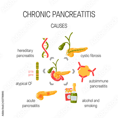 Causes of chronic pancreatitis concept. Vector illustration
