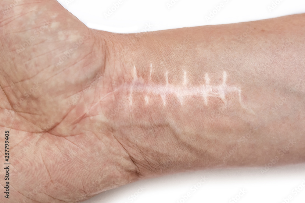 Scar with stitches on the wrist after surgery. Fracture of the bones of ...