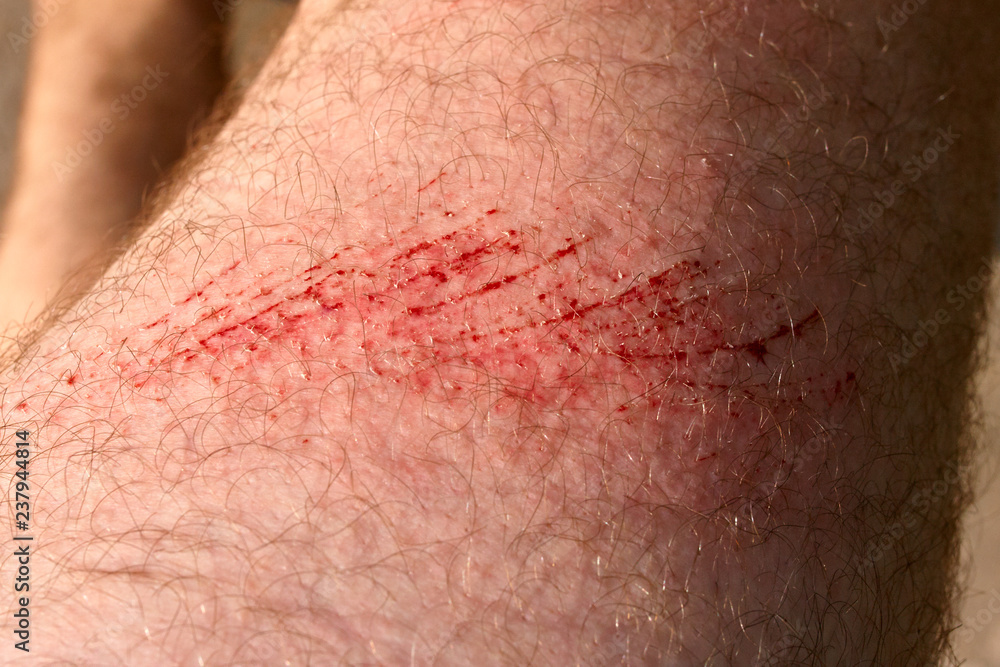 Foto de Scratch skin, wound or cut on the skin, red blood. Hairy part of a man body closeup do