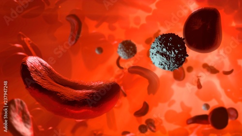 Sickle cell anaemia, illustration photo