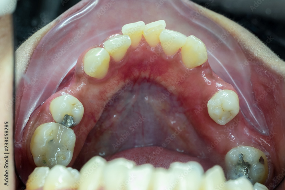 Obraz premium crowding teeth