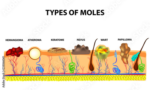Types of moles. Nevus, pigment spot, papilloma, wart, keratoma, atheroma, hemangeoma. Mole. Anatomical structure of the skin and hair. Infographics. Vector illustration on isolated background.