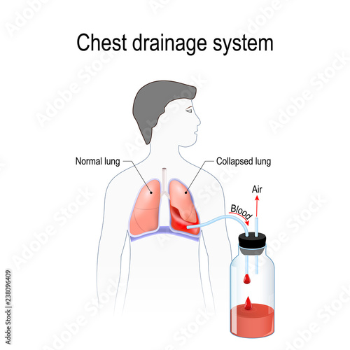 Hemothorax. Chest drainage system.