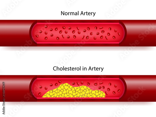 Comparison between normal artery and cholesterol in artery blood. vector