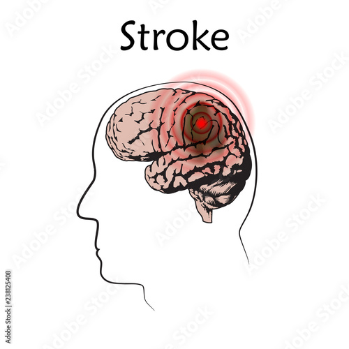 Stoke poster, banner. Vector medical illustration. White background, line silhouette of man head, anatomy flat image of damaged human brain.