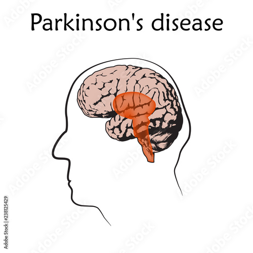 Parkinson's disease poster, banner. Vector medical illustration. White background, line silhouette of old man head, anatomy flat image of damaged human brain.