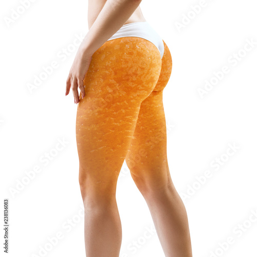 Obraz na płótnie Female buttocks with orange peel texture.