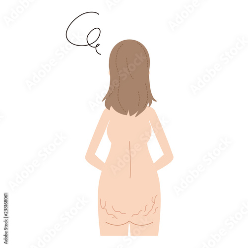妊娠線にショックを受ける妊婦