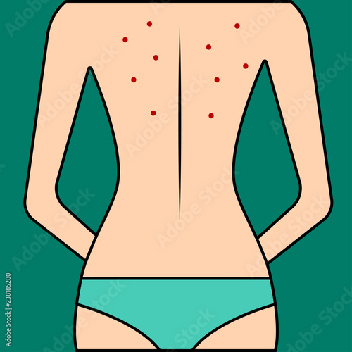 Acne on female back