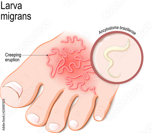 Cutaneous larva migrans. Skin disease in humans.