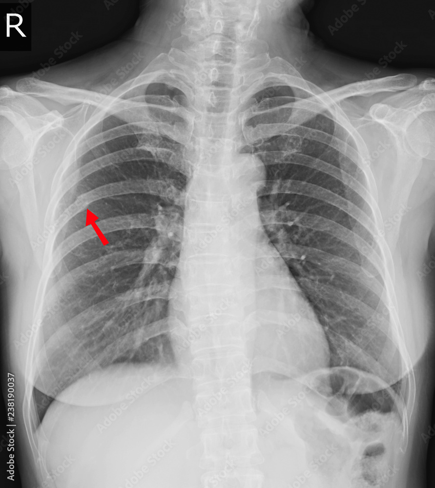 Chest xray Fracture right posterior 6th rib and possible fracture
