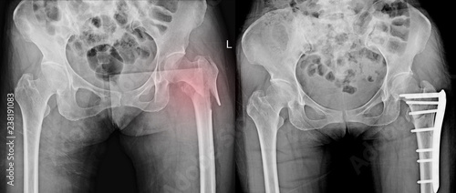 Fotografia Healed fracture neck left femur post fix with plate and screws