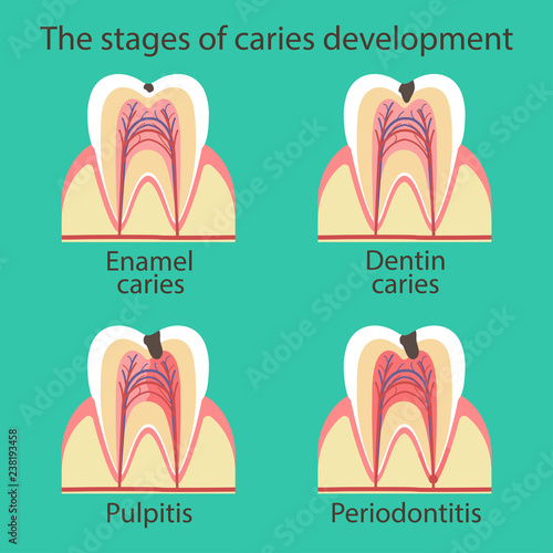 Stomatological concept. Development of dental caries, pathogenic microflora in the oral cavity. Vector illustration.