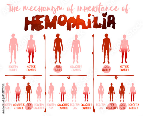 Hemophilia Infographics Image