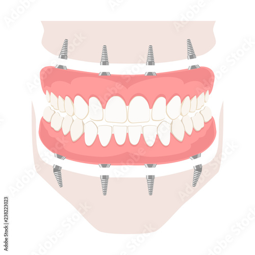 Removable denture on implants. Removable denture of the upper and lower jaw on four implants. Implant of the upper and lower jaw. Full arch prosthesis on dental implants. Vector illustration