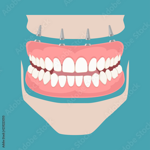 Removable denture on implants. Removable denture of the upper and lower jaw on four implants. Implant of the upper and lower jaw. Full arch prosthesis on dental implants. Vector illustration