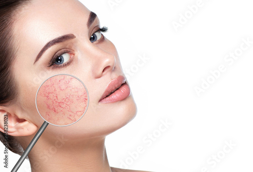 magnifying glass showing couperose on womans face photo