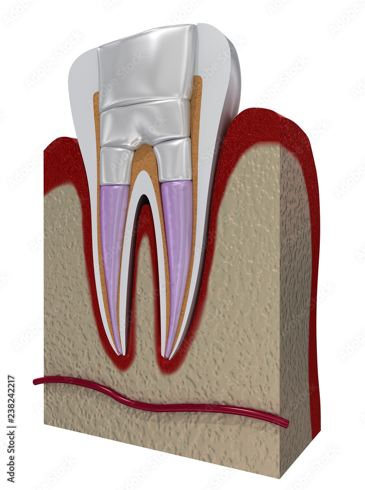 Dental fillings procedure diagramm . 3D illustration Stock Illustration