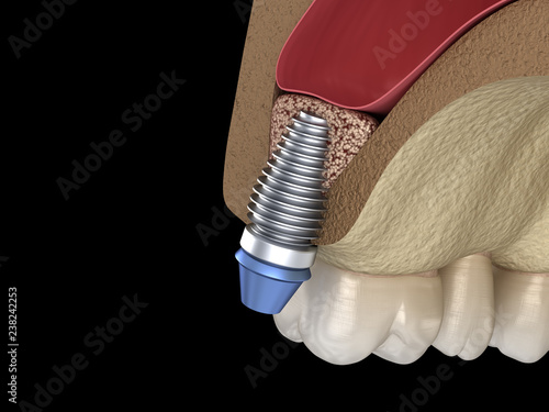 Sinus Lift Surgery - implant installation. 3D illustration photo