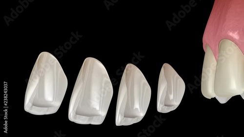 Veneer installation procedure over central incisor and lateral incisor. Medically accurate tooth 3D animation