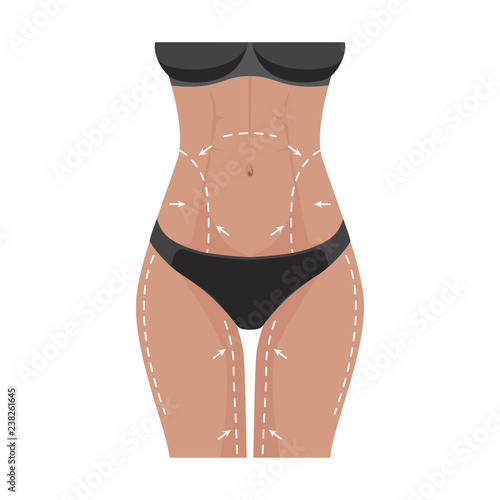 Concept of perfect body slimming weight loss liposuction. Surgical white lines on the female body, marks on the skin for plastic surgery. Vector illustration