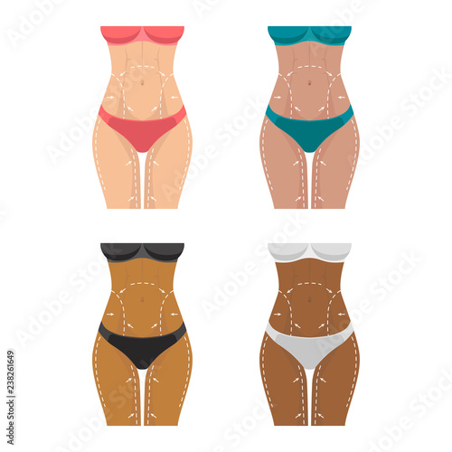 Concept of perfect body slimming weight loss liposuction. Surgical white lines on the female body, marks on the skin for plastic surgery. Vector illustration