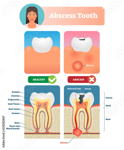 Abscess tooth vector illustration. Labeled medical diagram with structure.